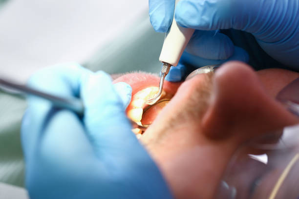 Best Emergency Tooth Extraction in West Tawakoni, TX