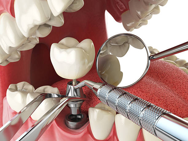 Best Emergency Root Canal Treatment in West Tawakoni, TX