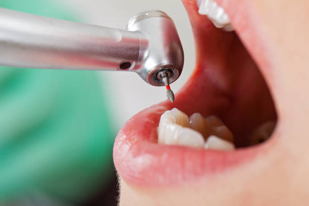 Best Emergency Tooth Extraction in West Tawakoni, TX